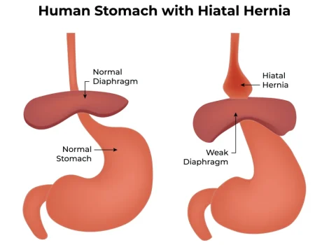 hiatal2